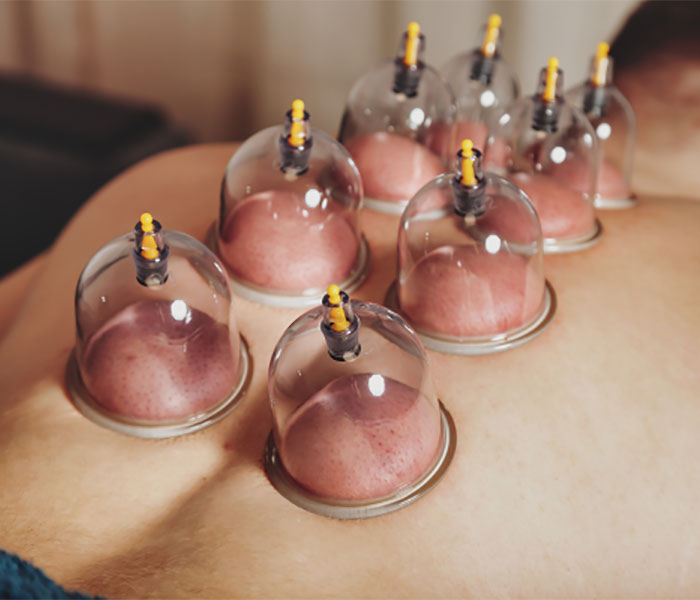Wet Cupping Therapy in Gurgaon